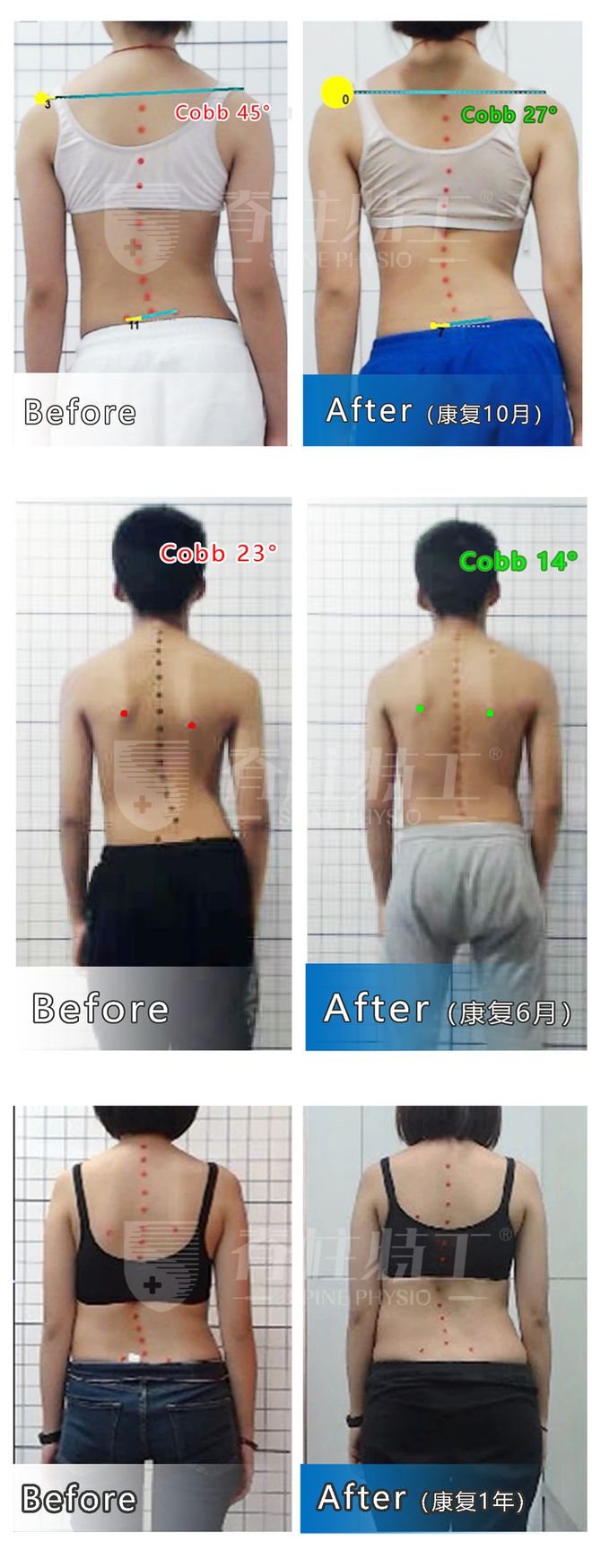 C型脊柱侧弯4个有效的康复训练(图5)